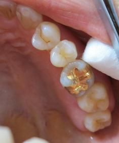 審美治療した奥歯の予後　１７年後の金歯の様子