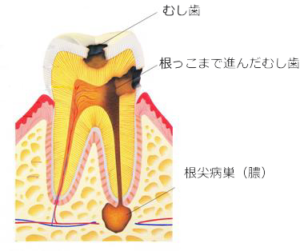 虫歯の断面