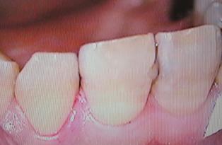 前歯3歯