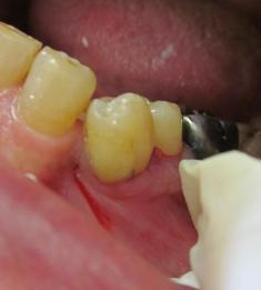 犬歯の隣の小臼歯