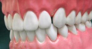 下の奥歯を白くきれいに　保険のプラスチックをやりかえ
