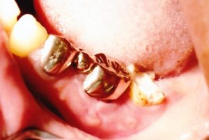 歯茎がはれる！歯茎の腫れの６つの原因と治療法　