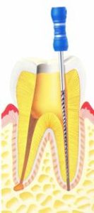 歯の根っこの治療器具