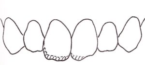 前歯