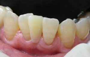 前歯　すきっ歯の治療　セラミックで審美治療