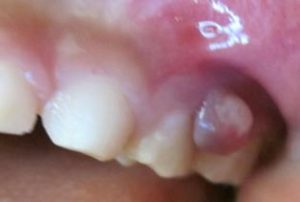歯茎がはれる！　子供の歯茎の腫れ　６つ原因と治療法