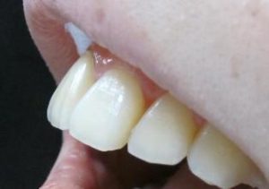 上の歯にすごく小さい歯があります。矮小歯の３つの治療法