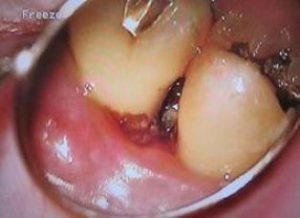 歯茎の下にある歯石