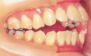 上の前歯と舌の前歯の間に舌を入れる癖