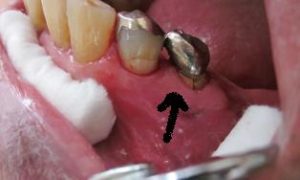 歯根破折の症状　４つの診断方法