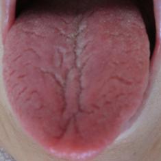 舌の溝