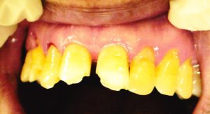 歯ぎしりの５つの治療法