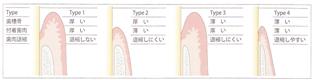歯肉と骨の厚みの関係をタイプ別に分類