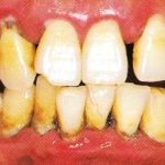 歯周病は人類史上最大の感染症