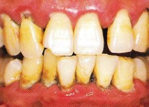 歯周病は人類史上最大の感染症