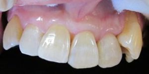 ダイレクトボンディング　前歯の審美治療　
