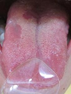 舌がピリピリします。地図状舌　推測される５つの病気