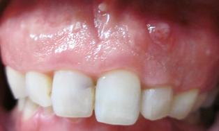 前歯の歯ぐきの上が腫れています