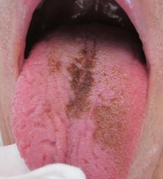 舌が黒い！黒毛舌の６つの原因と３つの治療法