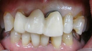 前歯の治療術前