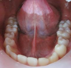 舌ったらずの原因って何？舌小帯短縮症の症状と治療法