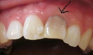 歯が灰色に変色してきた！変色歯の原因と２つの治療法