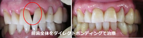 前歯のすきっ歯をダイレクトボンデイングで治療