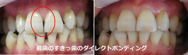 前歯のすきっ歯のダイレクトボンディング