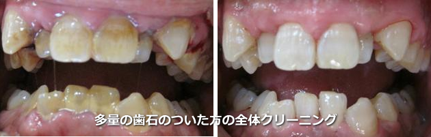 多量の歯石のついた歯のクリーニング