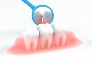 ガムが虫歯の原因になる４つの理由